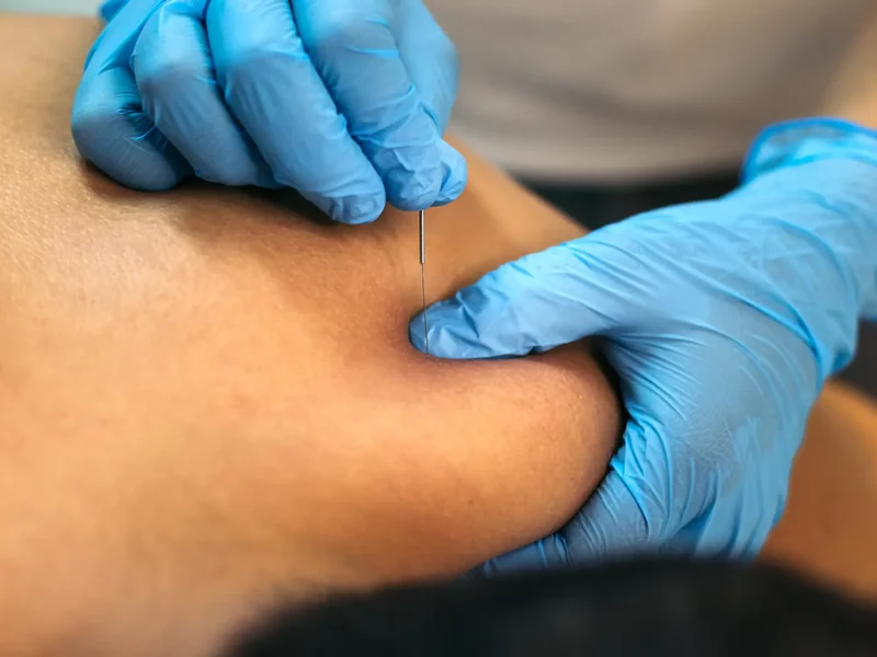 Physical therapist performing dry needling on a patient's shoulder
