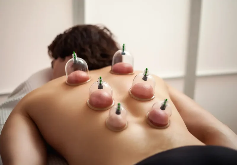 Physical therapist performing cupping with a patient