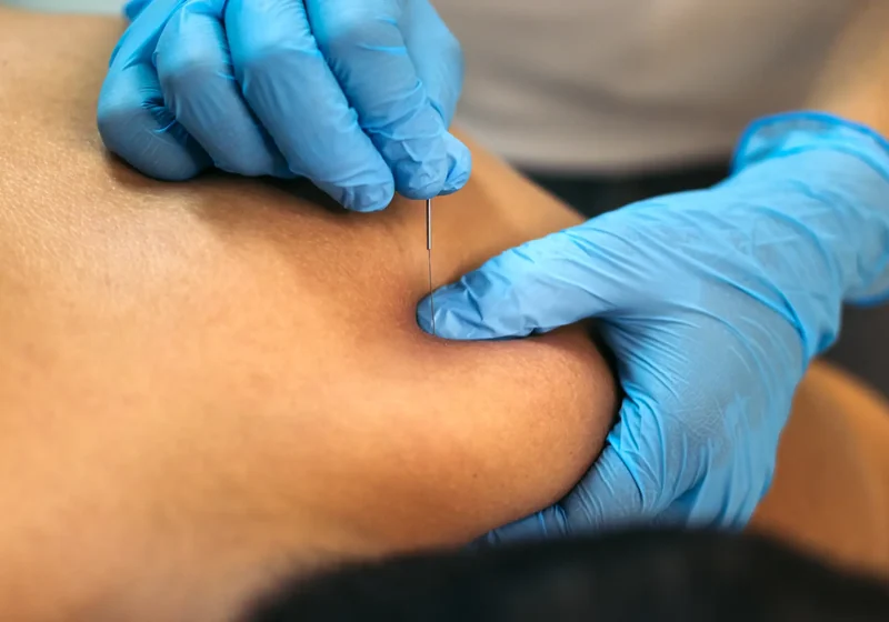 Physical therapist performing dry needling with a patient